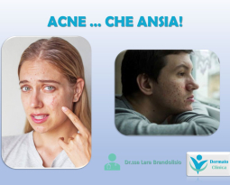 ACNE… WHAT ANXIETY!