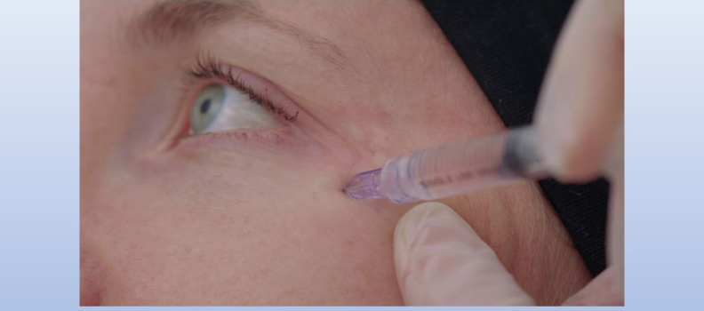 NEW DEVICE FOR SKIN BIOREVITALISATION IN SENSITIVE AREAS